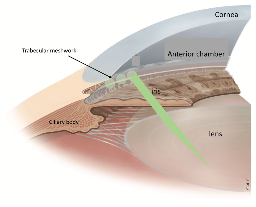 cruzar Borde ballena azul Glaucoma Information Laser trabeculoplasty - Glaucoma Information