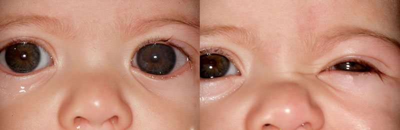 acute glaucoma in babies