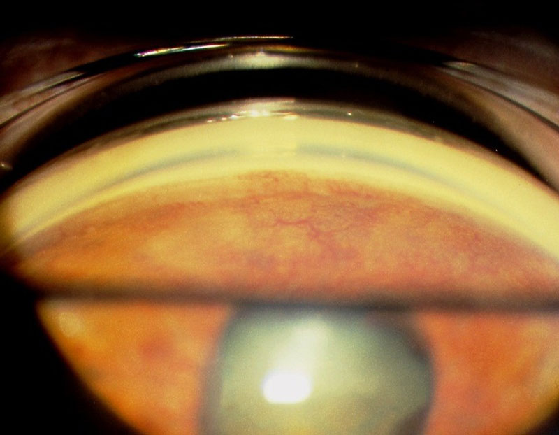 Glaucoma secundário -Diabetes pode causar glaucoma? Glaucoma neovascular Fig. 3