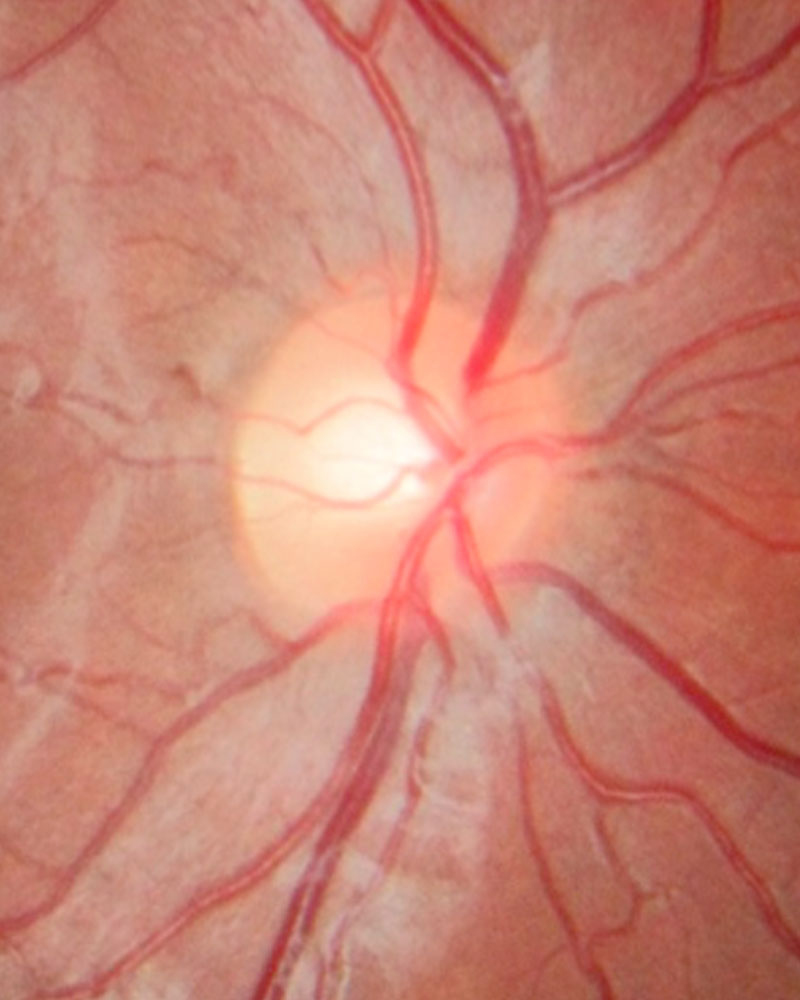 Glaucomatous optic disc Fig. 1